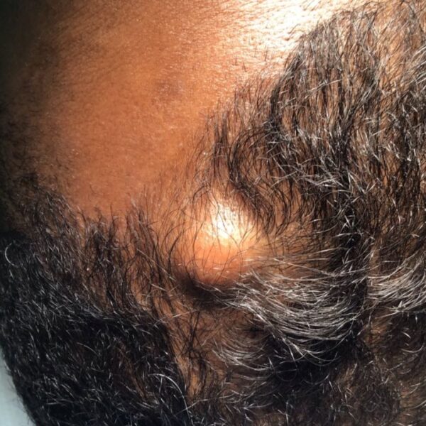 Cyst Removal in London - Same Day Treatment from £295
