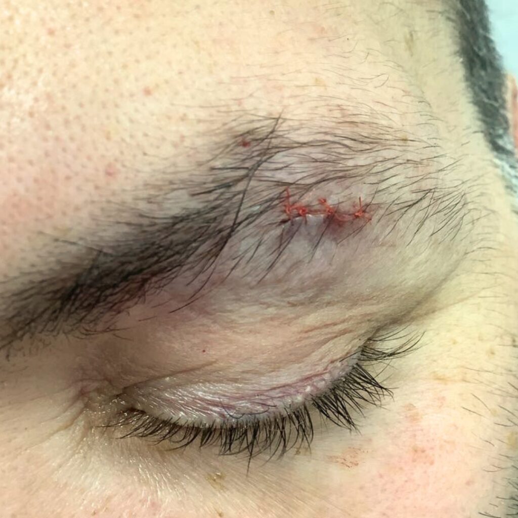Eyebrow Cyst Removal | Pilomatrixoma Excision & Treatment
