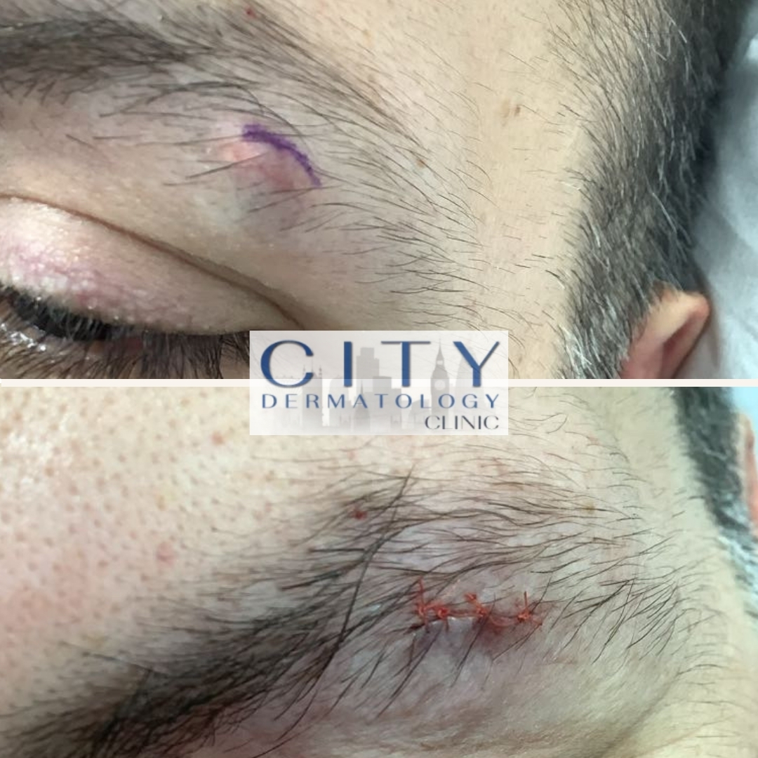 Eyebrow Cyst Removal Pilomatrixoma Excision Treatment eyebrow-cyst-removal-pilomatrixoma-excision-treatment